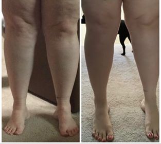 photo of my legs before and now